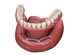 Was ist ein implantatgetragener Zahnersatz?