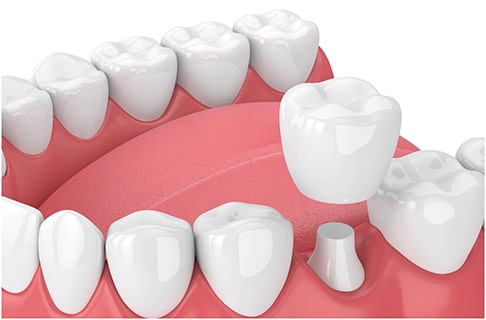 Was ist eine Zahnkrone?