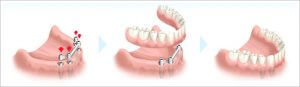 Was sind implantatgetragene Prothesenpakete?